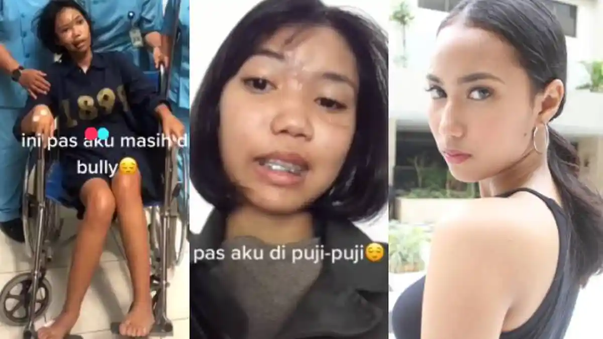 Viral Dulu Dibully, Wajahnya Hancur Akibat Kecelakaan, Kini Menjelma Jadi Model, Gak Nyangka!