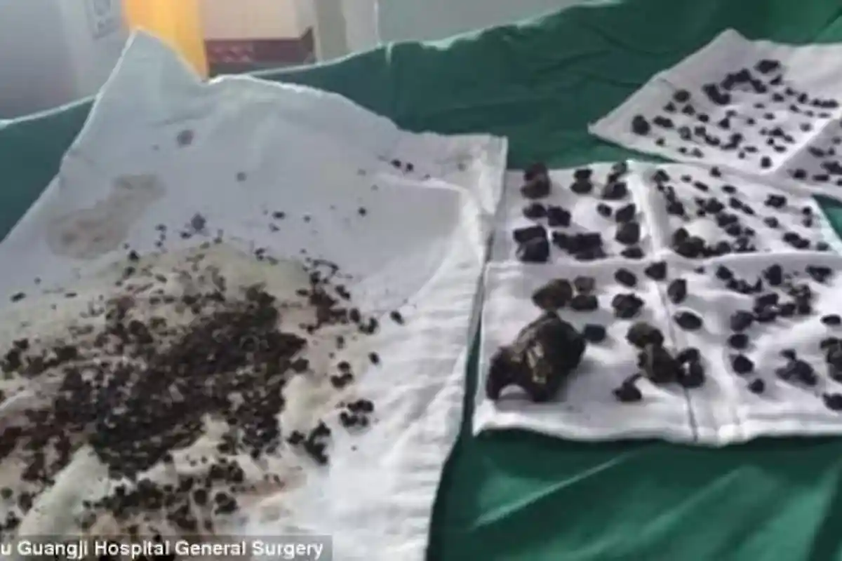 Dokter Temukan 200 Batu Ginjal di Dalam Empedu dan Hati Wanita Ini, Penyebabnya Sering Kita Lakukan!