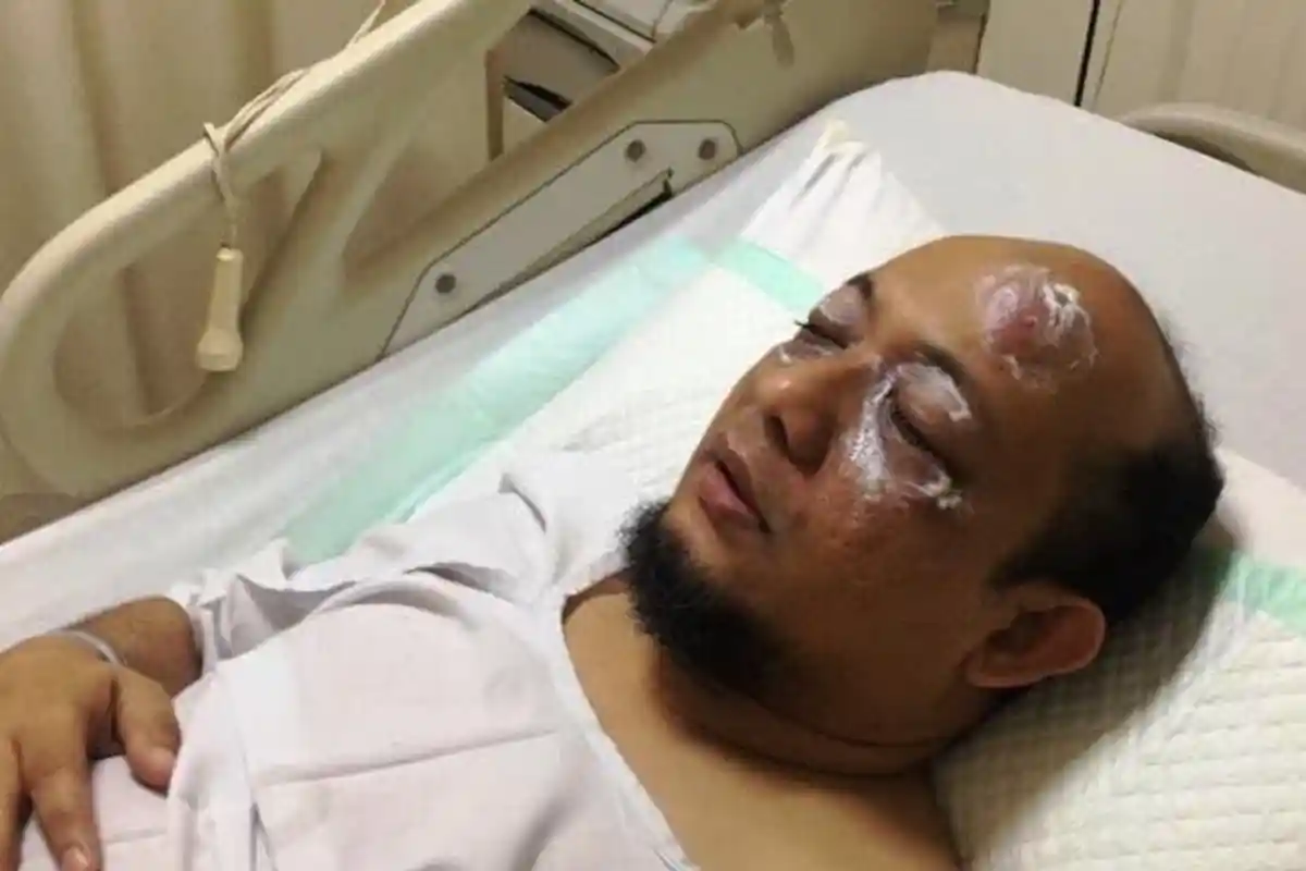 Peradangan, Kondisi Bola Mata Novel Sempat Merapat dengan Casing