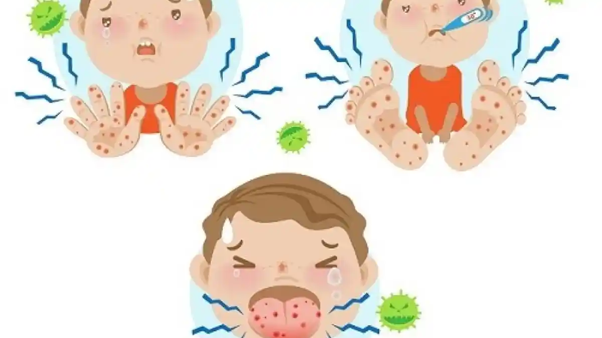 Viral Curhat Ibu yang Anak Balitanya Idap Penyakit Kawasaki, Dari Demam, Ruam dan Bibir Pecah-pecah
