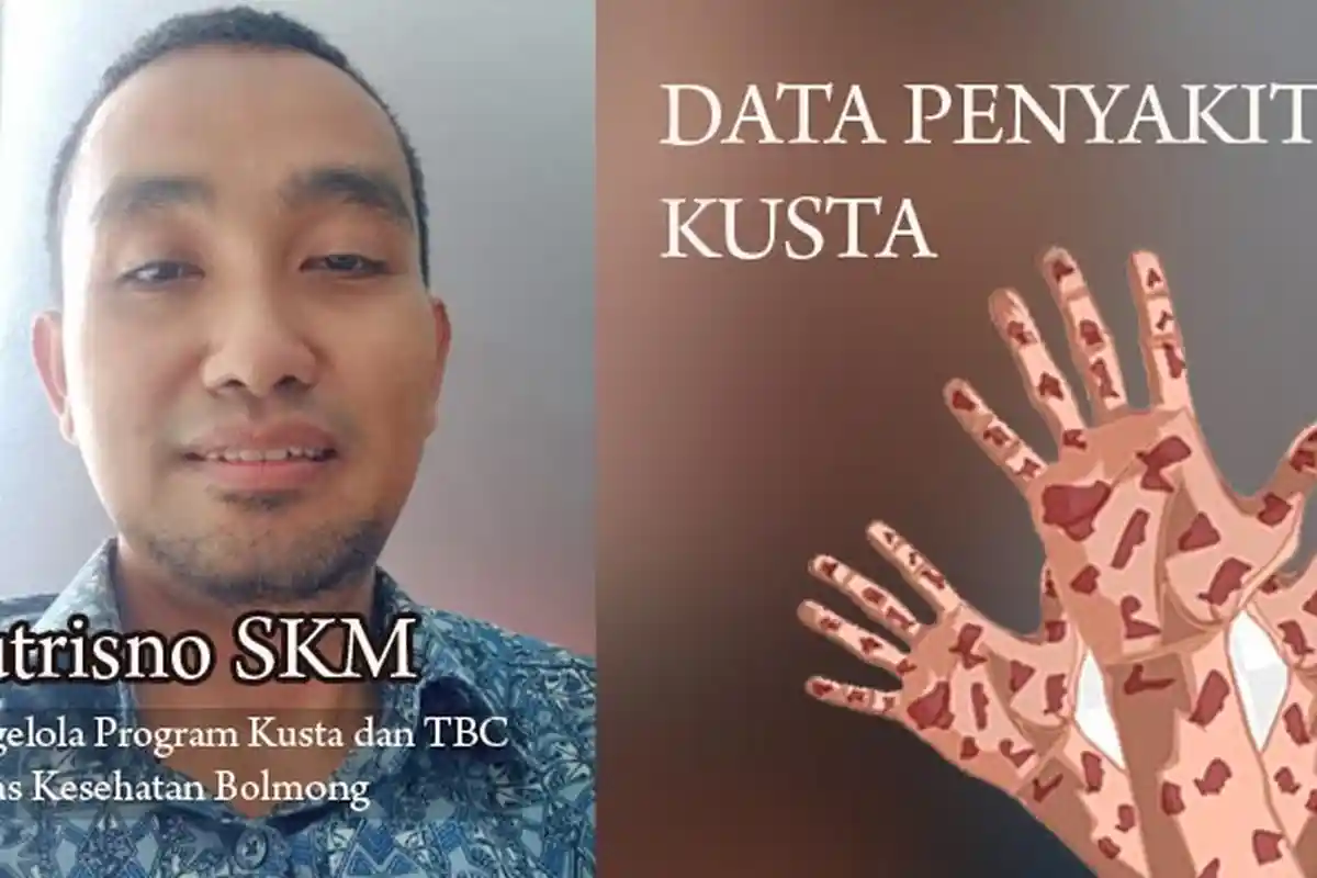 Berikut Data Penderita Penyakit Kusta di Bolaang Mongondow Sulawesi Utara 5 Tahun Terakhir