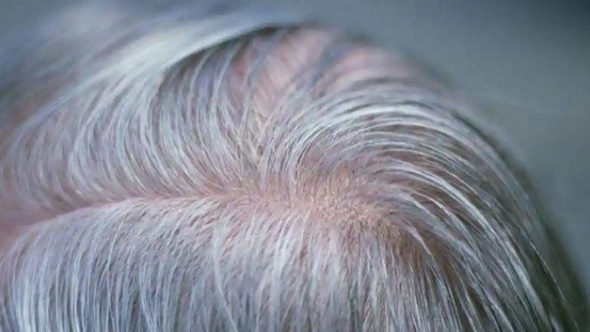 Solusi Rambut Beruban: Bawang Merah dan Kapur Barus, Bagaimana Caranya?