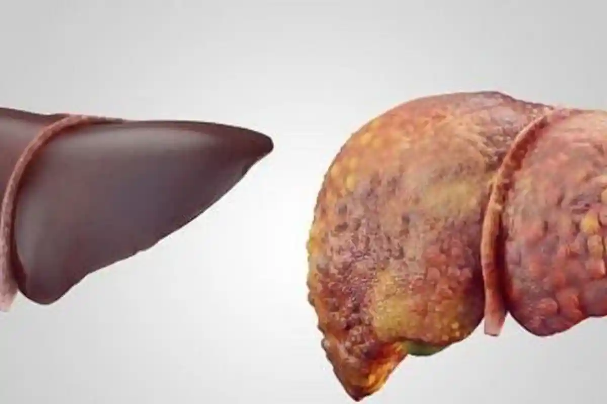 7 Ciri Seseorang Idap Penyakit Liver Kronis, Simak Juga Cara Mecegahnya