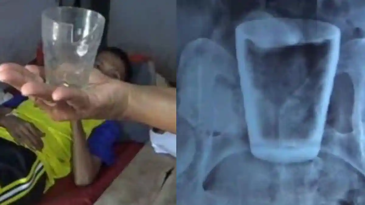 Ada Gelas di Dalam Perut Warga Jember, Pihak RS Ungkap Hasil Analisa, Sebut Bisa Masuk Lewat Sini