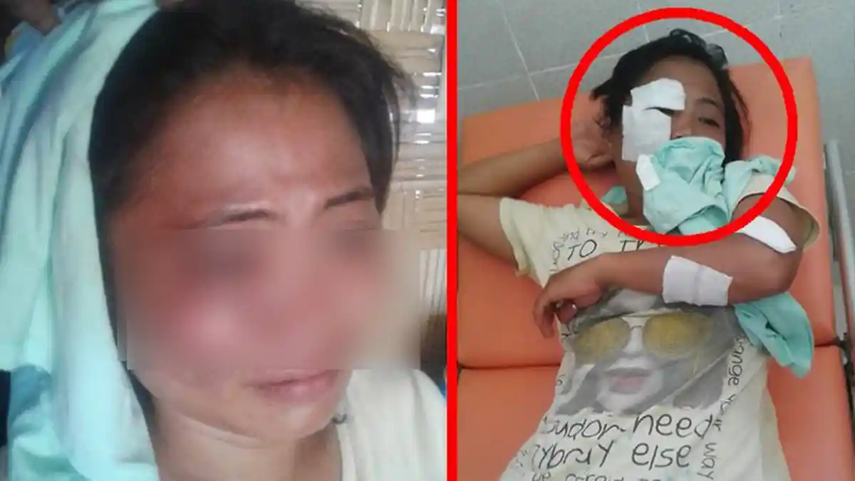 Tanwin Hungopa Lapor Polisi Wajahnya Disetrika Suami