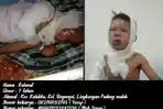 Bocah-tujuh-tahun-di-Kalukku-menderita-luka-bakar-di-tubuhnya.jpg