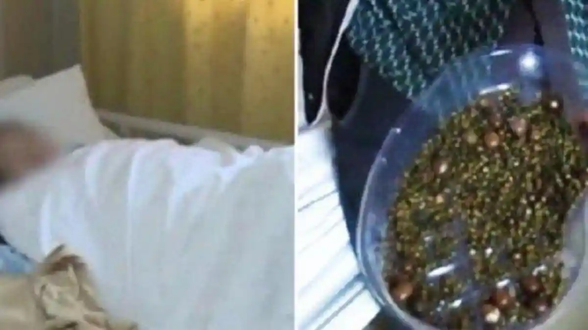 Gejala Batu Empedu, Mirip dengan Sakit Jantung, Liver hingga Usus Buntu