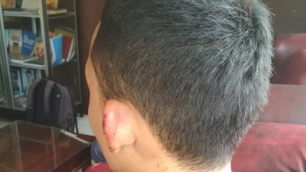 Balada Smartphone Berujung Tindak Kekerasan, Kakak Kandung Tega Gigit Telinga Adik