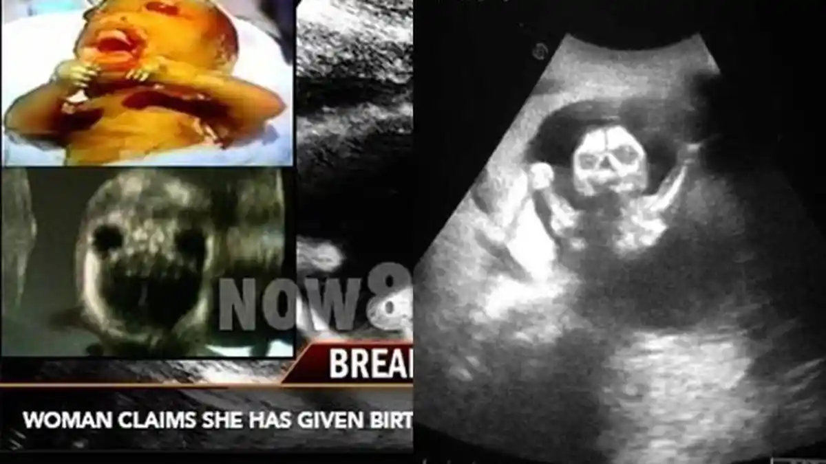 Perut Terasa Dicakar Selama Hamil, Ibu ini Lahirkan 'Bayi Setan' , Bertahan Tanpa Air Ketuban