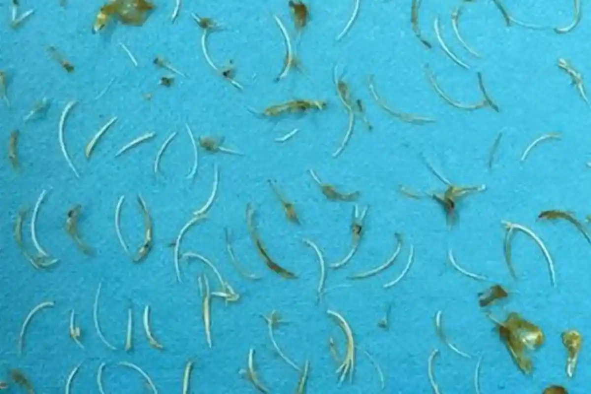 Dokter Temukan 100 Duri Ikan di Perut Pria Ini, Dokter Harus Lakukan Operasi Sulit dengan Resiko Ini