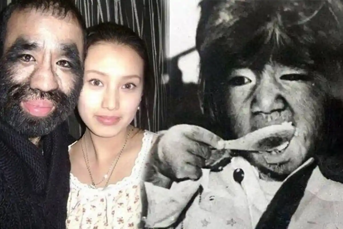 Seorang Ibu Syok Anaknya Terlahir Penuh Bulu bak 'Kera' Puluhan Tahun Kemudian Nasibnya Mengejutkan