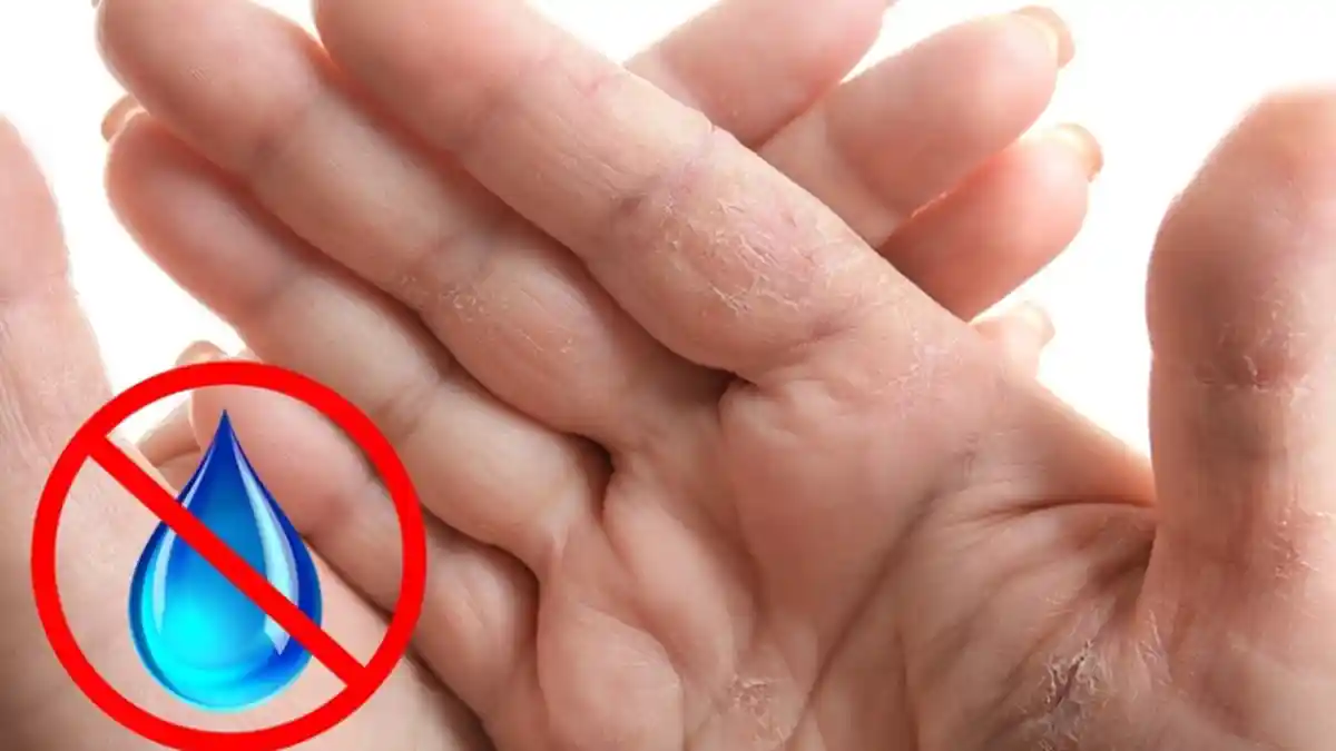 6 Cara Mengatasi Kulit Tangan Kering Tanpa Ribet, Pakai Alpukat hingga Madu Murni