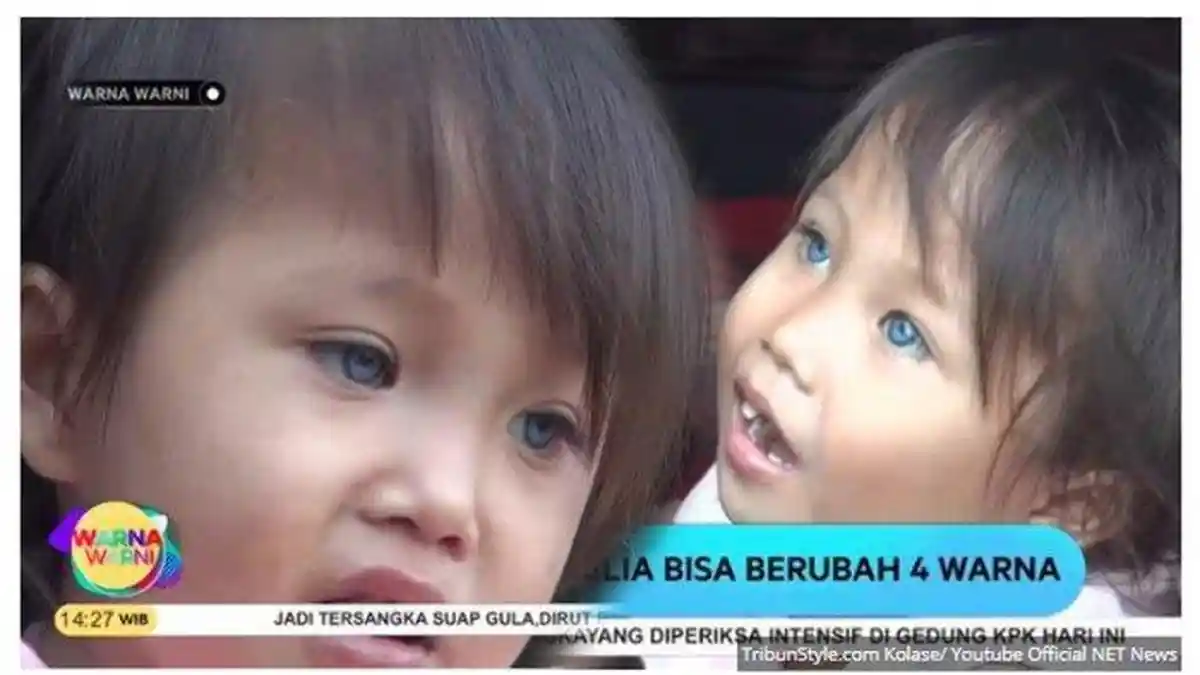 Viral! Amel, Bocah Bandung Bola Matanya Berubah Warna, Saat Lahir Dikira Buta, Begini Kondisinya