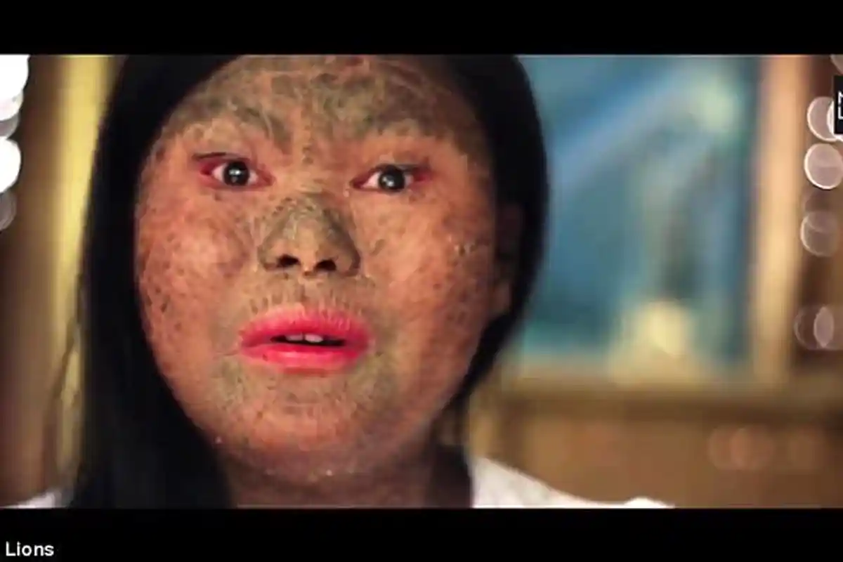 Tampak Seperti Ular, Sekujur Kulit Wanita ini Mengeras karena Kondisi Langka