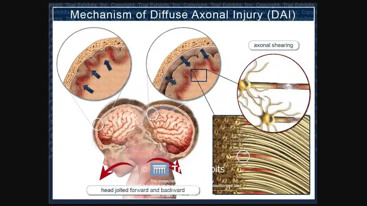5 Hal yang Perlu Diketahui tentang Diffuse Axonal Injury, Pengertian hingga Kemungkinan untuk Sembuh