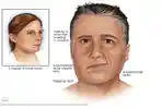 bells-palsy-11.jpg