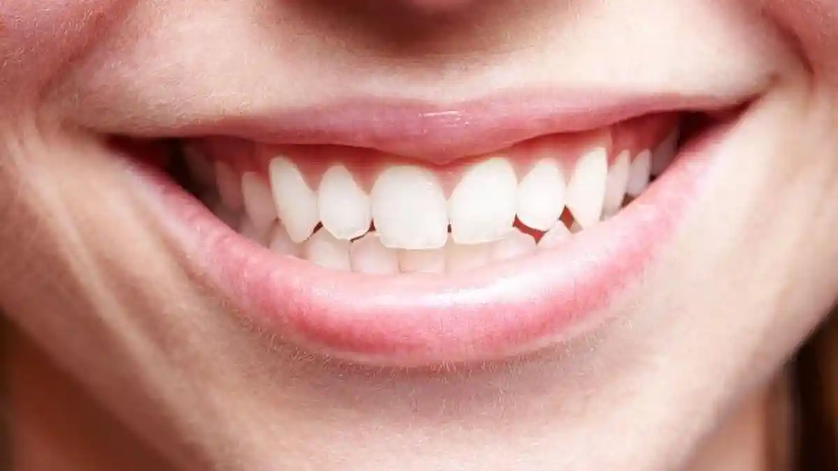 Apakah BPJS Bisa Dipakai Pembersihan Karang Gigi di Puskesmas?