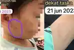 Viral Bocah 3 Tahun Digiggit & Dicakar Teman Sekolah, Terjadi Selama 5 Bulan Tapi Malah Dikeluarkan