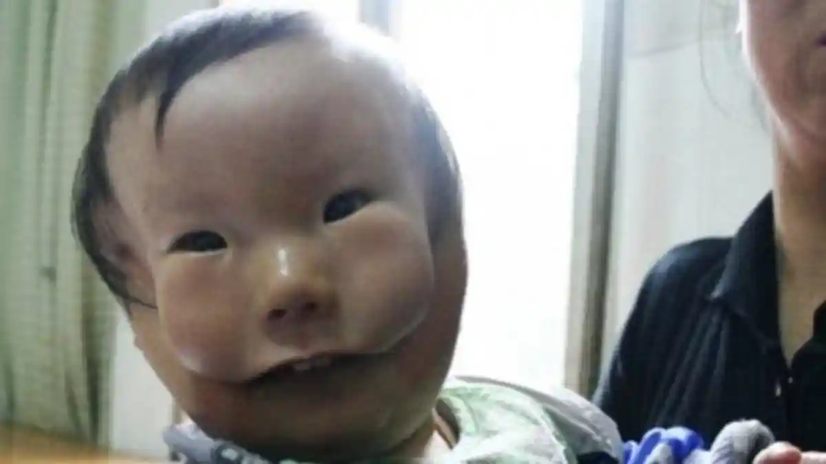 Terlahir Tak Normal, Bayi Ini bak Memiliki 2 Wajah