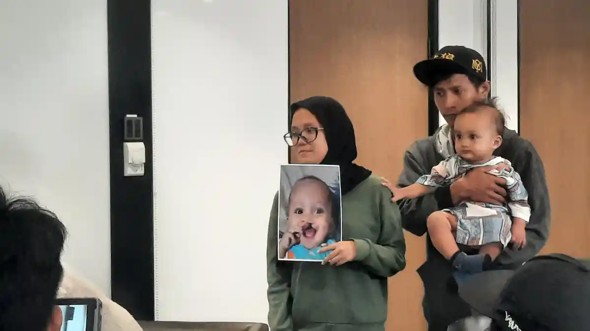 Cara Aman Beri ASI atau Susu pada Bayi yang Lahir dengan Kondisi Bibir Sumbing
