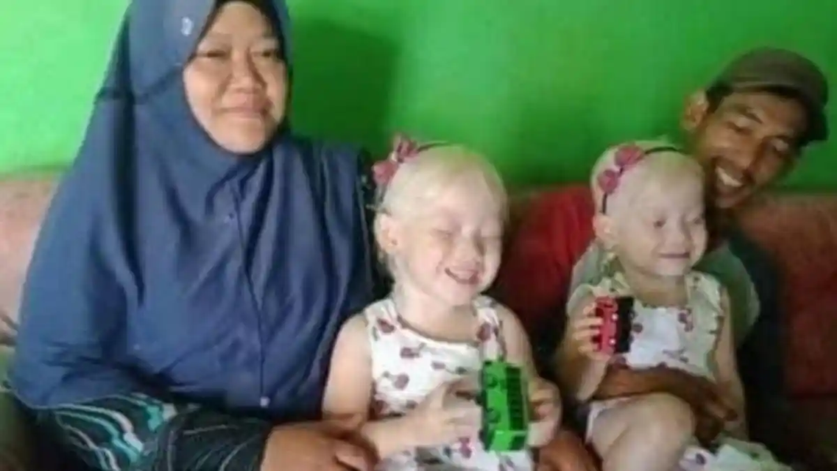 Apa Itu Albino? Kondisi yang Dialami Nadya dan Nadira Bocah Kembar di Wonogiri, Rambutnya Putih
