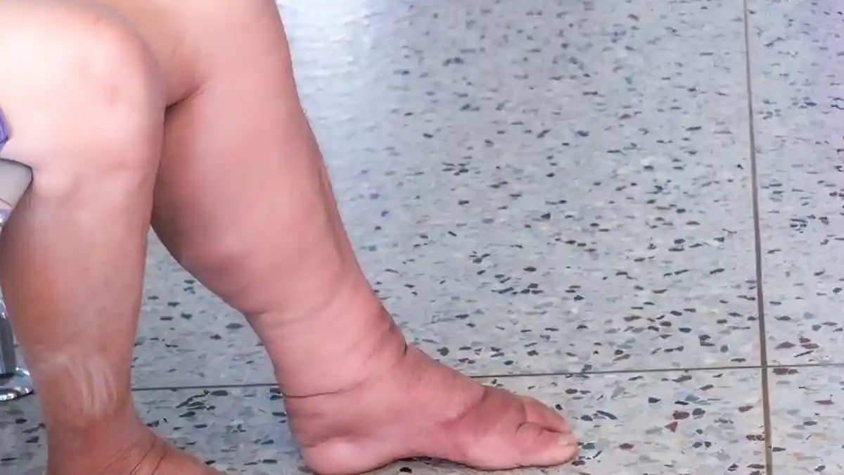 Kenali Apa Itu Penyakit Kaki Gajah, Penyebab, Gejala, Hingga Cara Mengobatinya