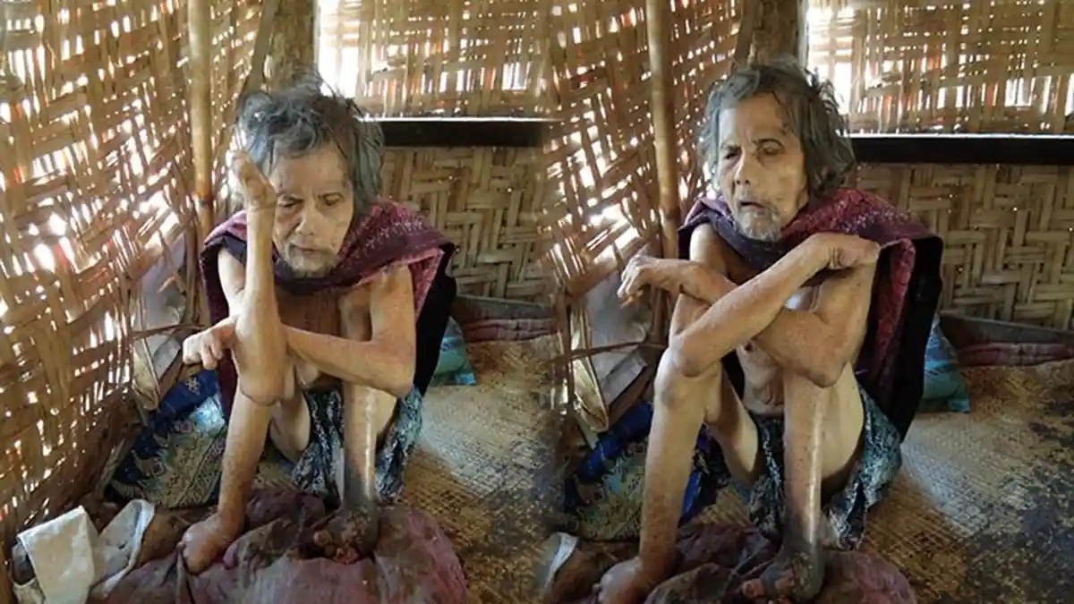 Kisah Sedih Pekak Nengah Nendra Alami Lepra & Hidup Sebatang Kara
