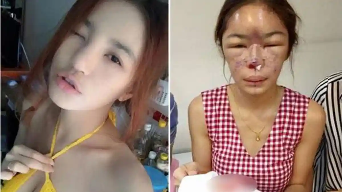 Wajah Model Thailand jadi Mengerikan Gara-gara Operasi Plastik