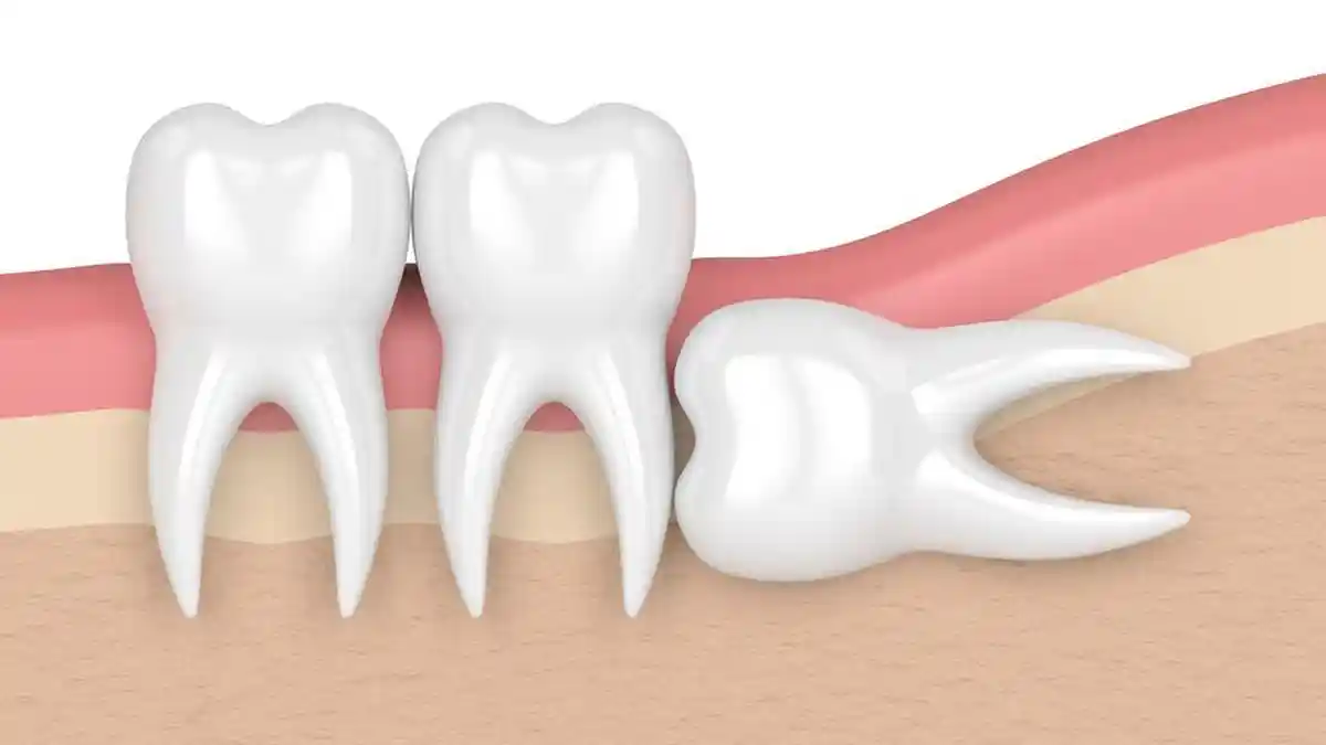 Apa Itu Odontektomi? Ini 7 Prosedur Pembedahan Gigi Bungsu Impaksi