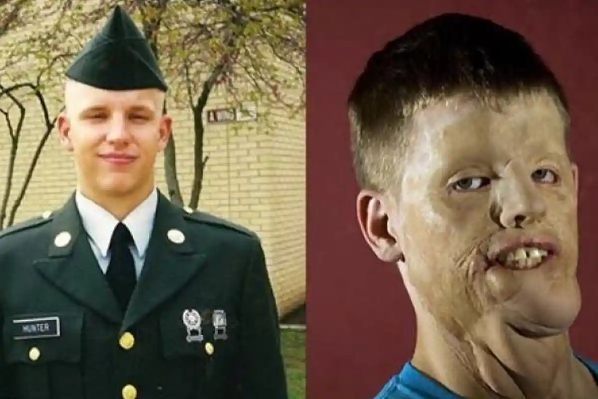 Wajahnya Rusak Parah Karena Kecelakaan, Lihat Perubahan Pria Ini usai 14 Tahun Jalani Operasi