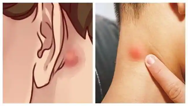 Benjolan di Leher Jangan Dianggap Sepele, Bisa Jadi Tumor Tiroid Jinak atau Ganas