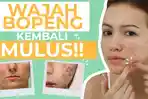 atasi-muka-bopeng.jpg