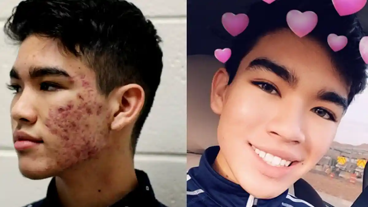 6 Cara Ampuh  Mengobati Jerawat yang Membandel, contoh Jangan Pencet Jerawat