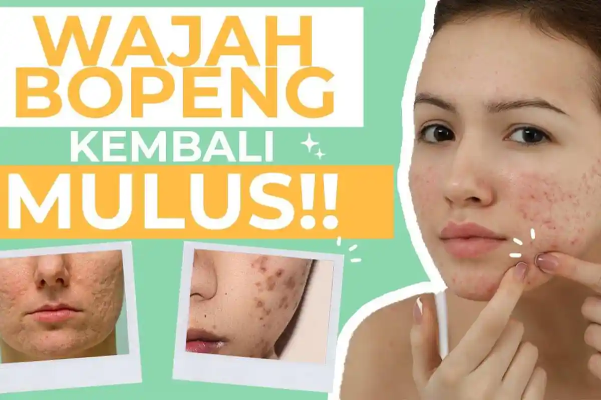 5 Cara Mudah Menghilangkan Bopeng dengan Menggunakan Bahan Alami Tanpa Rasa Sakit