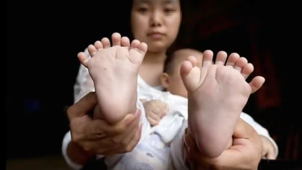 Memprihatinkan! Mengidap Kelainan Polidaktili, Bayi 8 Bulan Ini Punya 31 Jari!