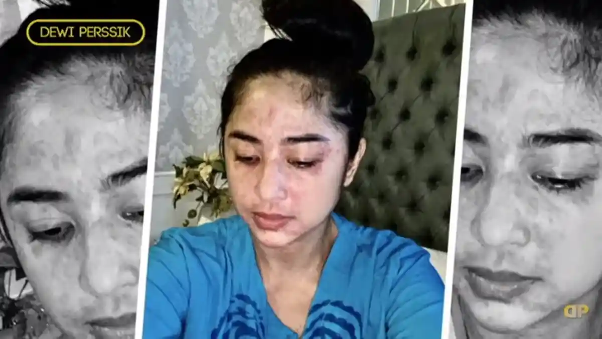Dewi Perssik Alami Ruam Merah Saat Positif Covid-19, Bisakah Disembuhkan ?