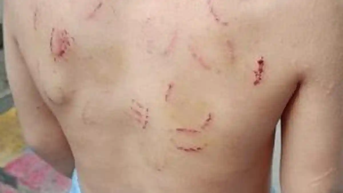 Bocah 3 Tahun di Cakung, Punya Luka Bekas Gigitan dan Benda Tajam Diduga KDRT dari Ibu Tirinya