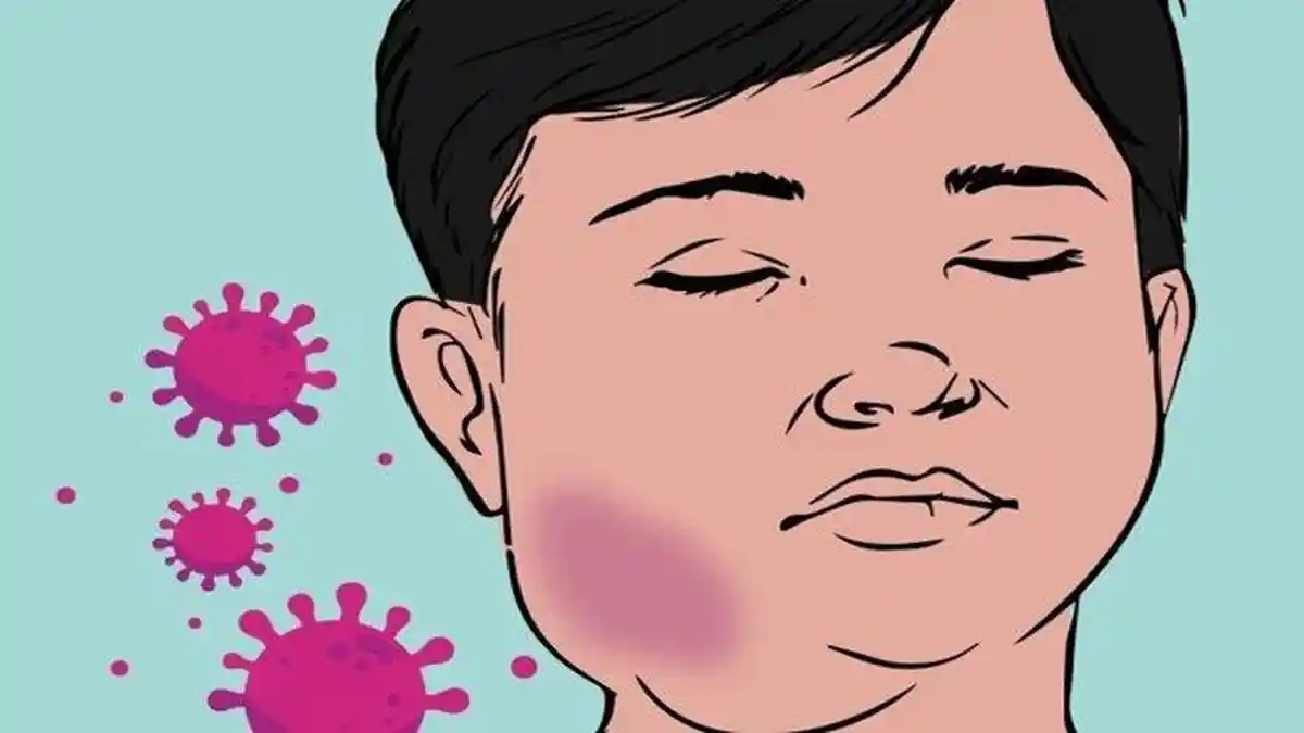 1.200 Anak di Demak Terinfeksi Penyakit Gondongan, Mayoritas Siswa SD
