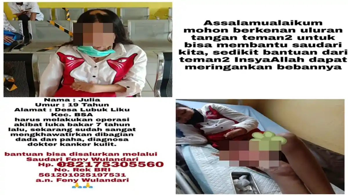 Idap Kanker Kulit, Julia Warga di Buay Sandang Aji OKU Selatan Terbaring Lemah, Butuh Bantuan Dana