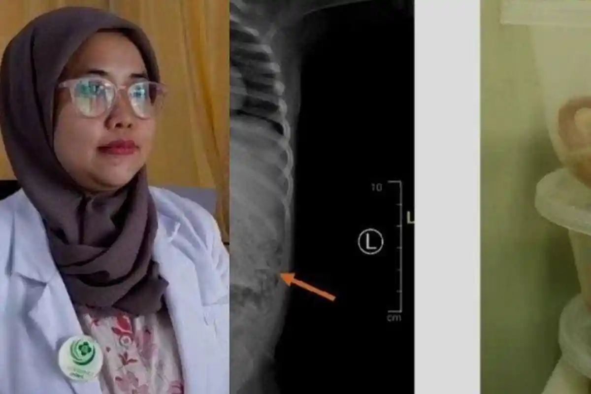 Setelah Dioperasi Cacing di Perut Bocah Jember Capai 3 Toples, Terungkap Darimana Asalnya