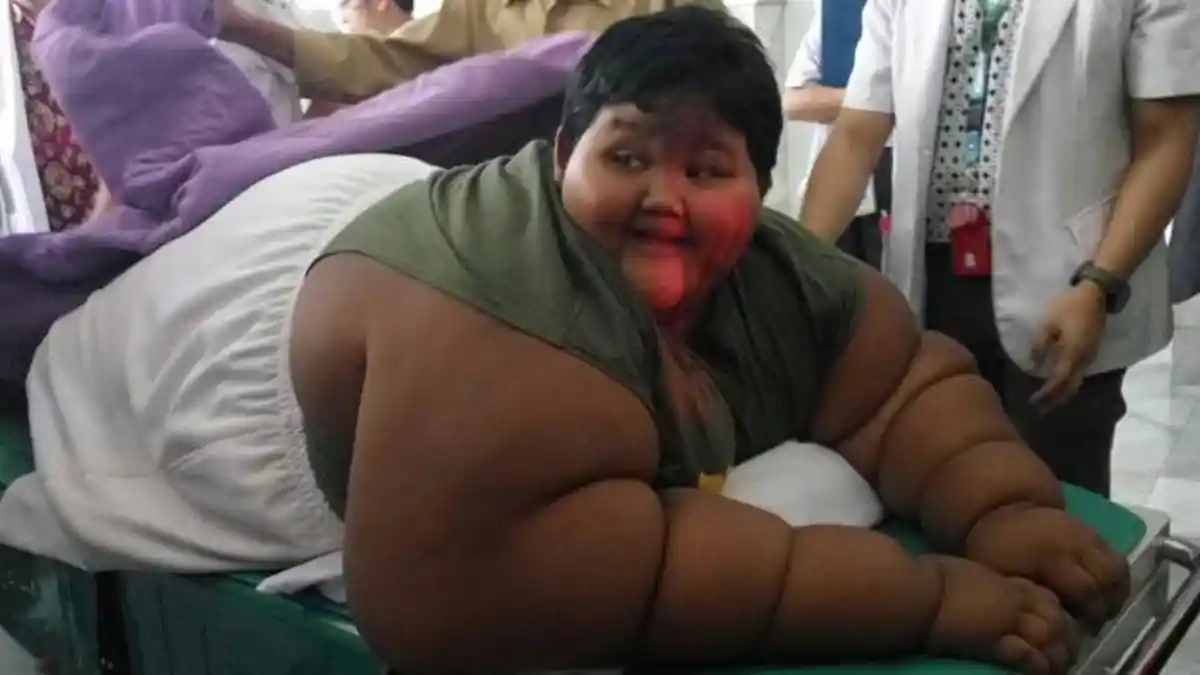 RS Hasan Sadikin Libatkan 13 Dokter Spesialis untuk Tangan Bocah Obesitas dengan Berat 189 Kg