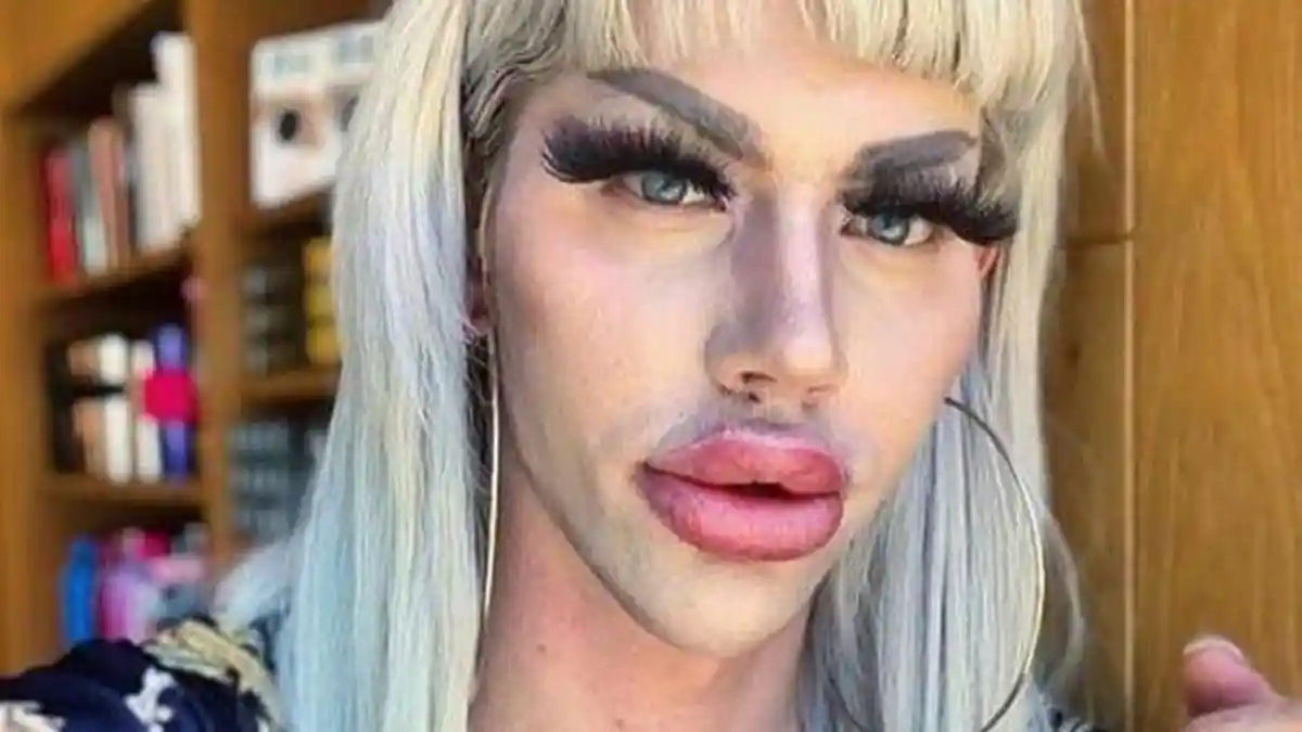 Demi Terlihat Seperti Barbie, Pria Ini Nekat Oplas, Habiskan Uang Rp 280 Juta, Wajahnya Jadi Begini