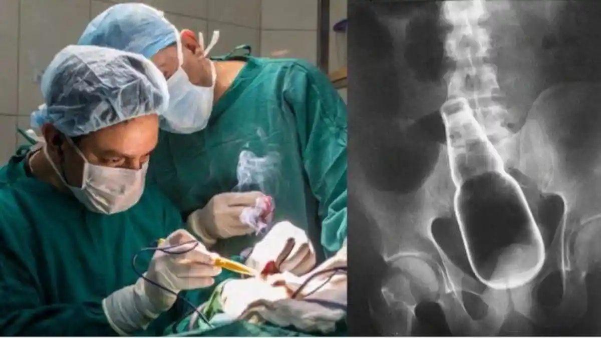 Pria ini Mampu Telan Botol Anggur dan 2 Kabel Charger Ponsel saat Mabuk Berat, Dokter Sampai Bingung