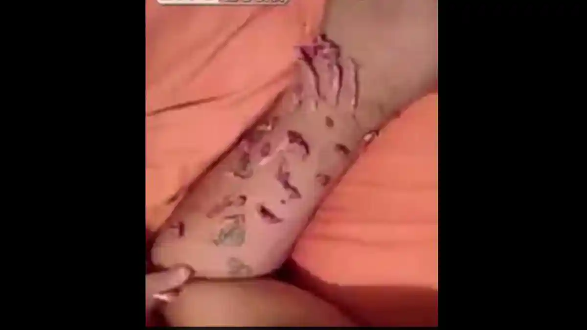 VIDEO: Tidak Kuat Jangan Melihat, Mengerikan, Ini yang Terjadi Pada Tato yang Terinfeksi