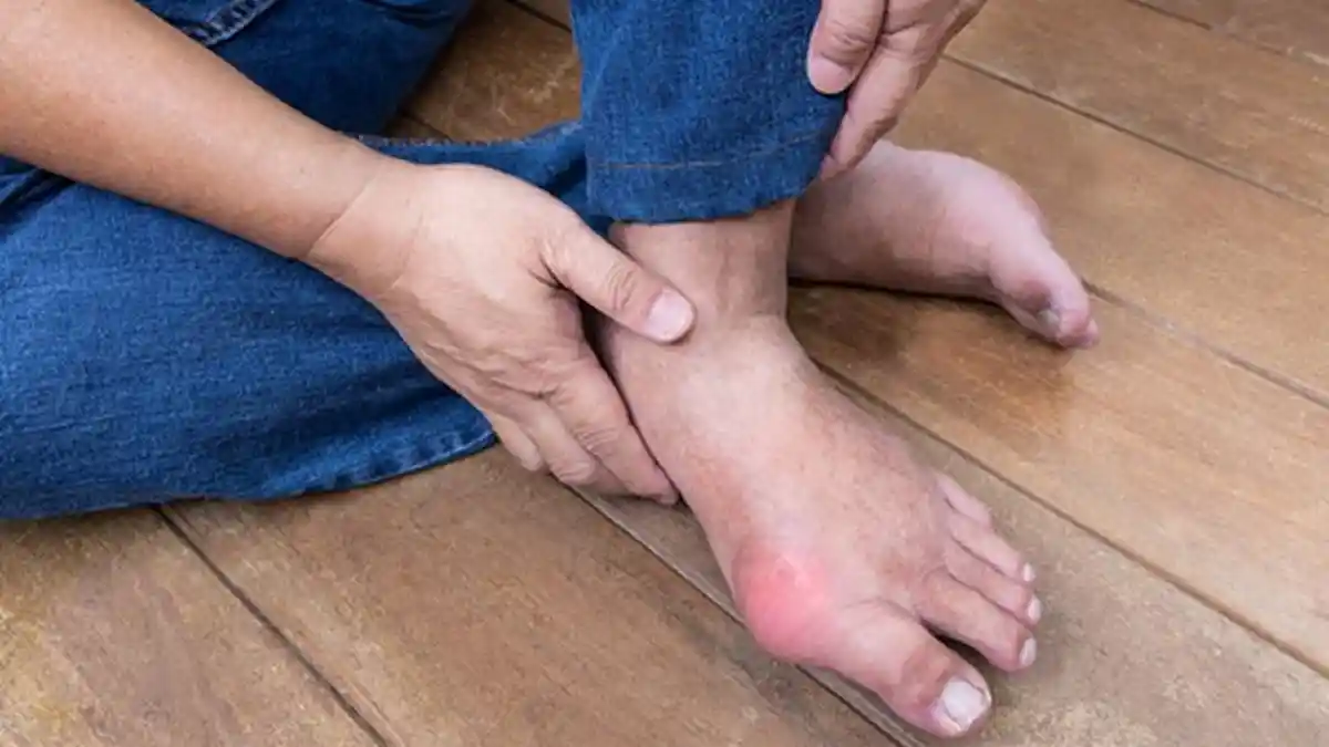 Cara Atasi Kapalan, Juga Penyakit Kutil yang Mengganggu di Tangan dan Kaki