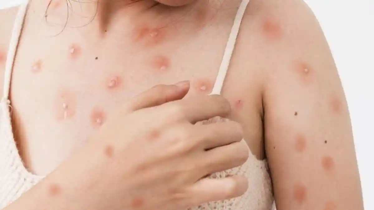 Terpapar Virus Cacar Monyet? Langkah Pertama Apa yang Harus Dilakukan? Ini Caranya