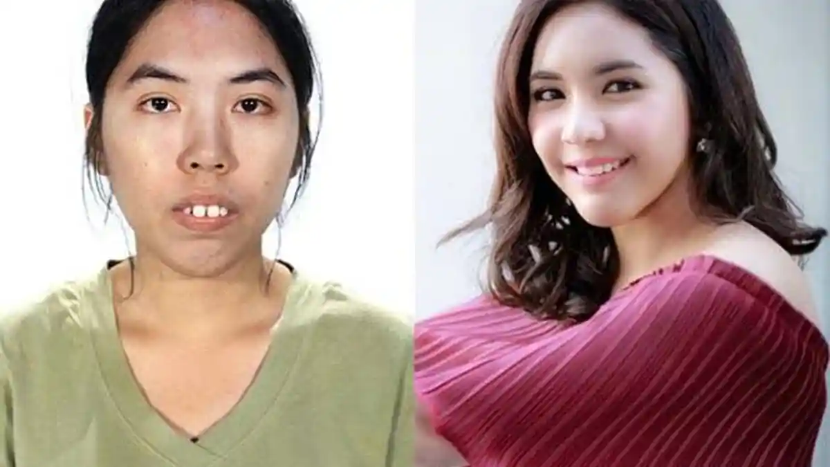 Si Gadis Bergigi Tonggos Kini Cantik dan Memesona, Kok Bisa Ya?