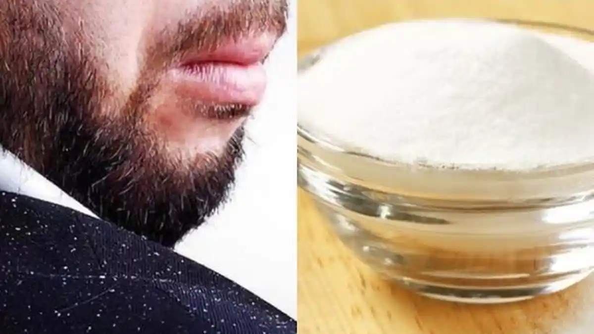 Anda Mengalami Ketombe, 7 Bahan Rumahan Ini Dipercaya Ampuh Hilangkannya, Ada Baking Soda