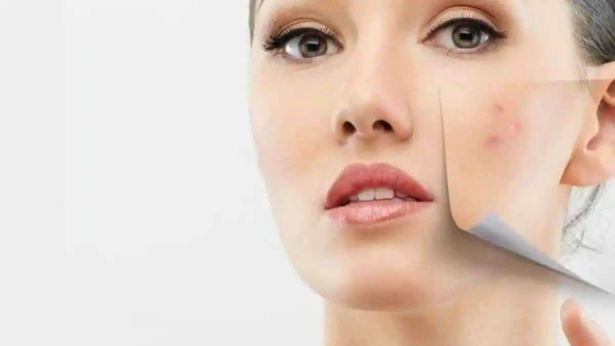 10 Bahan Alami yang Ampuh Menghilangkan Jerawat, Mudah Dilakukan Sendiri di Rumah