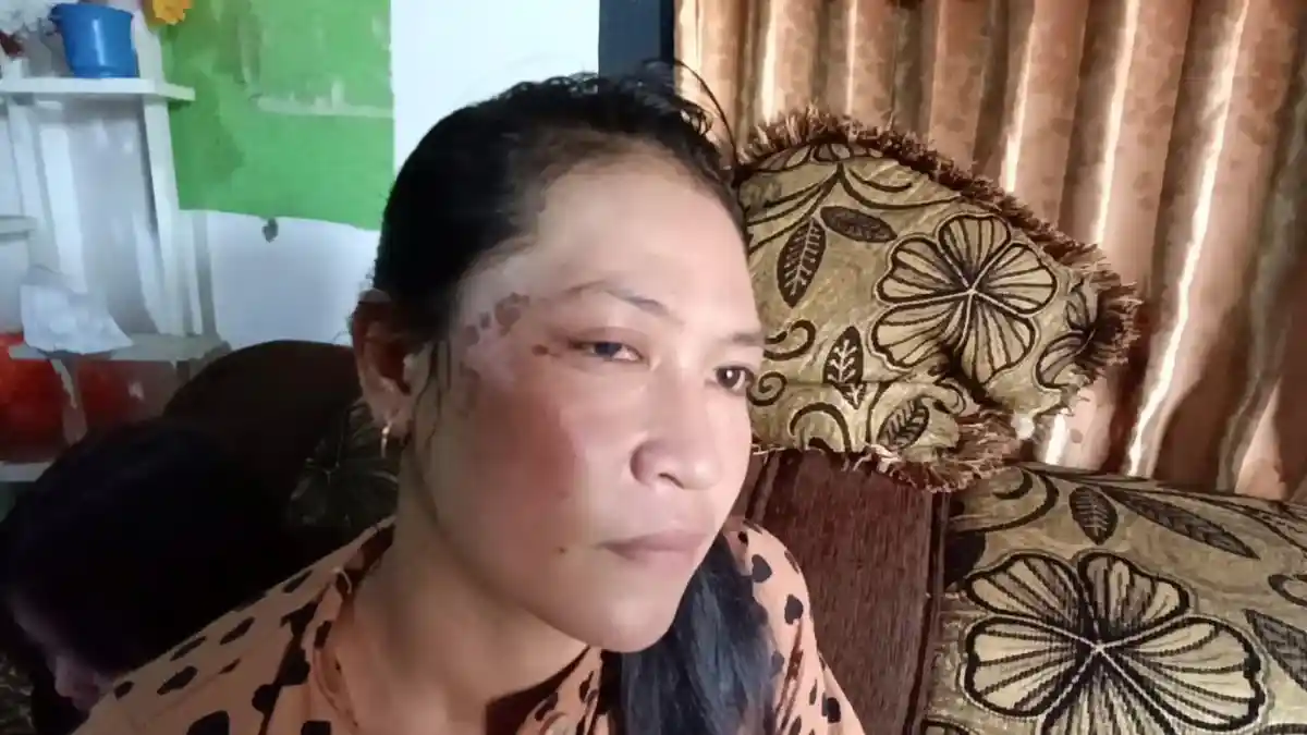 Begini Kondisi Terkini Korban Penyiraman Air Keras di Kerinci